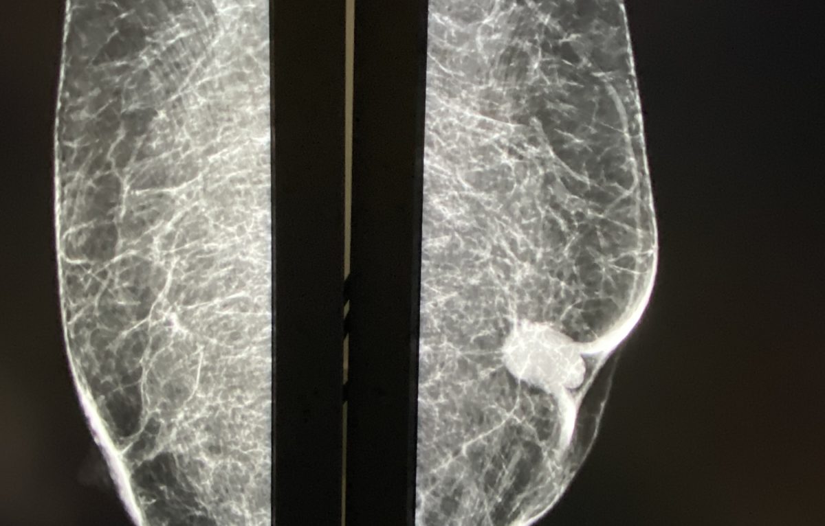 Image d'un cancer du sein chez un homme, en mammographie.  © Julien Puget 